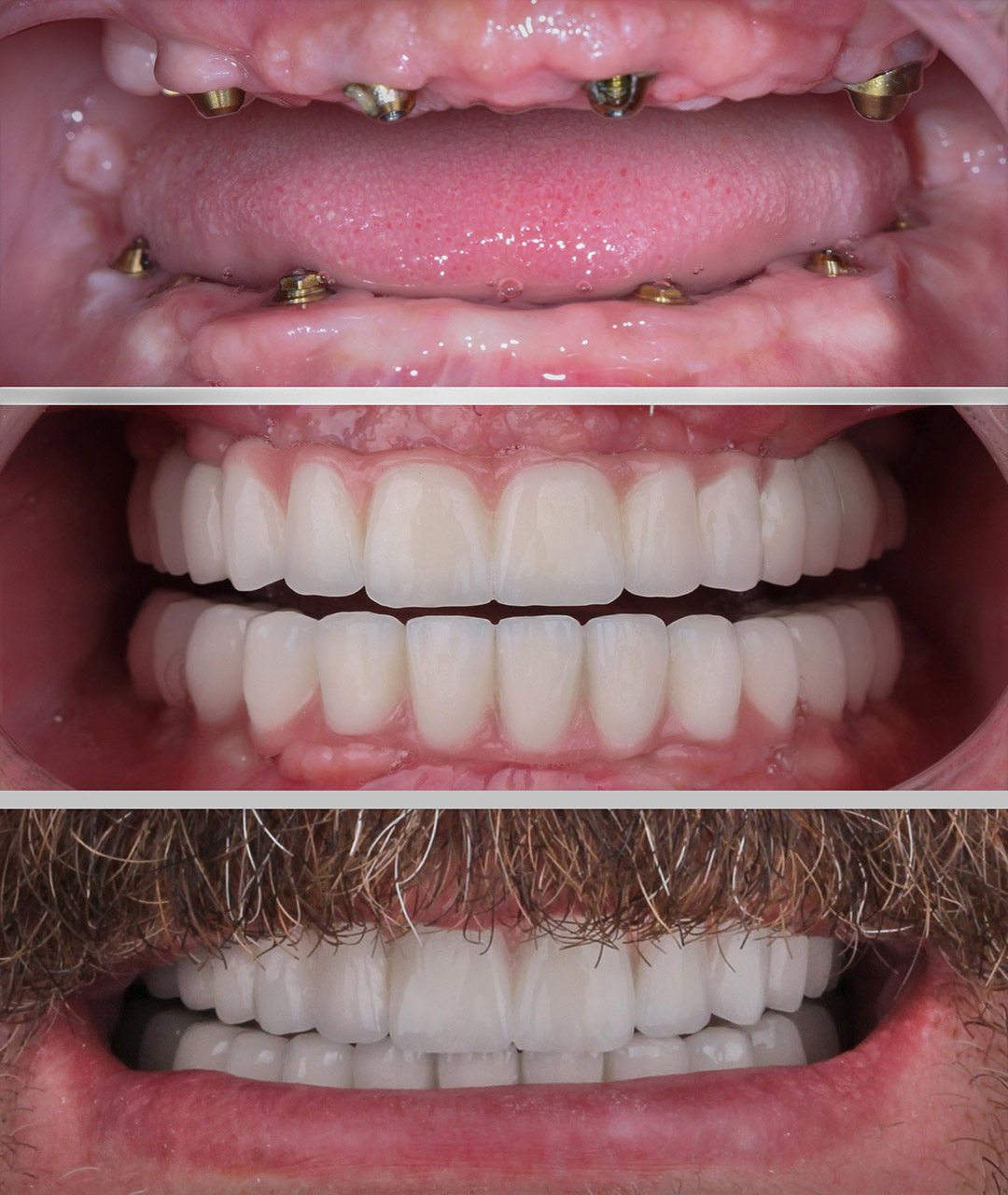 Full-Mouth Dental Implants