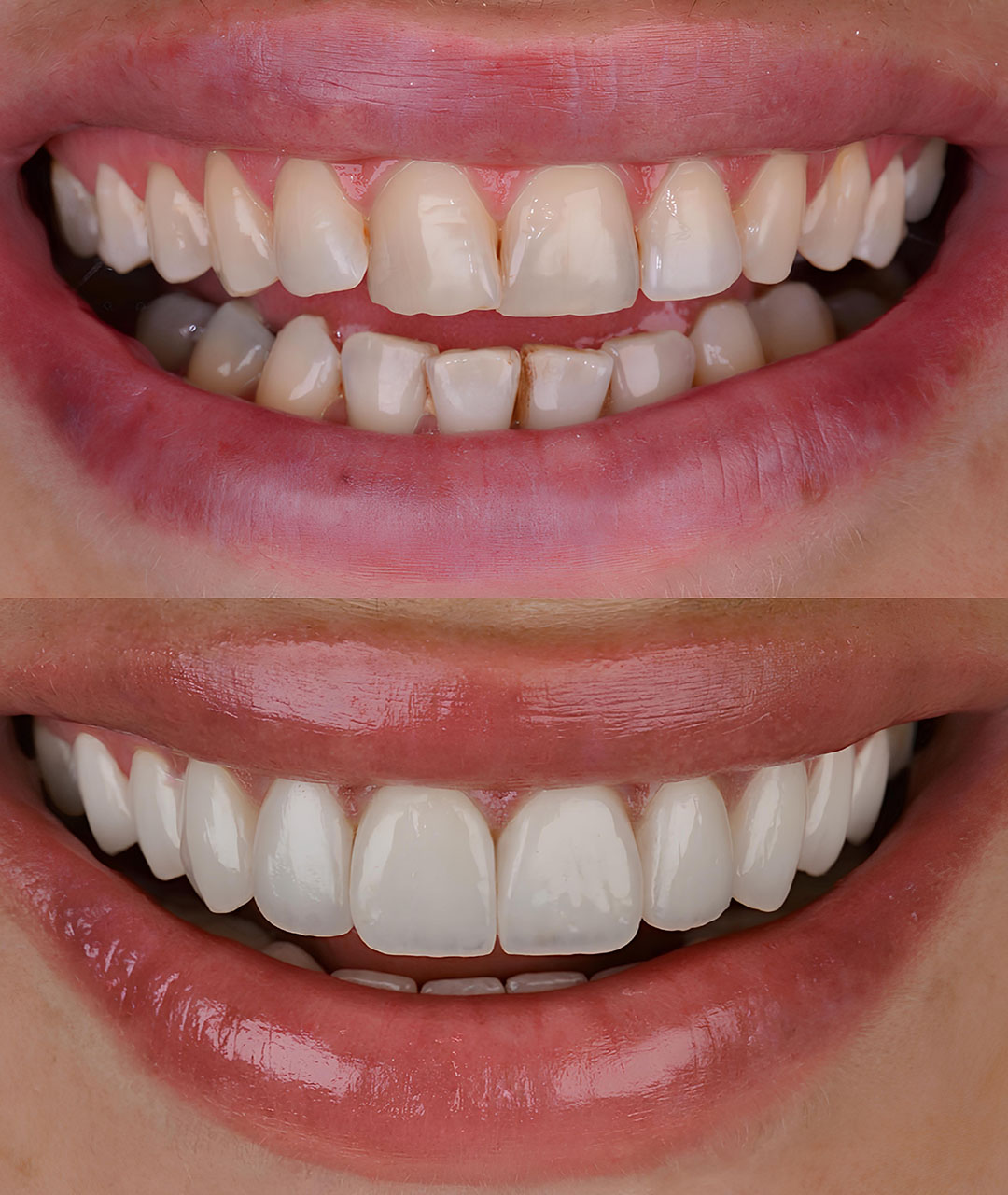 Cosmetic Smile Makeovers