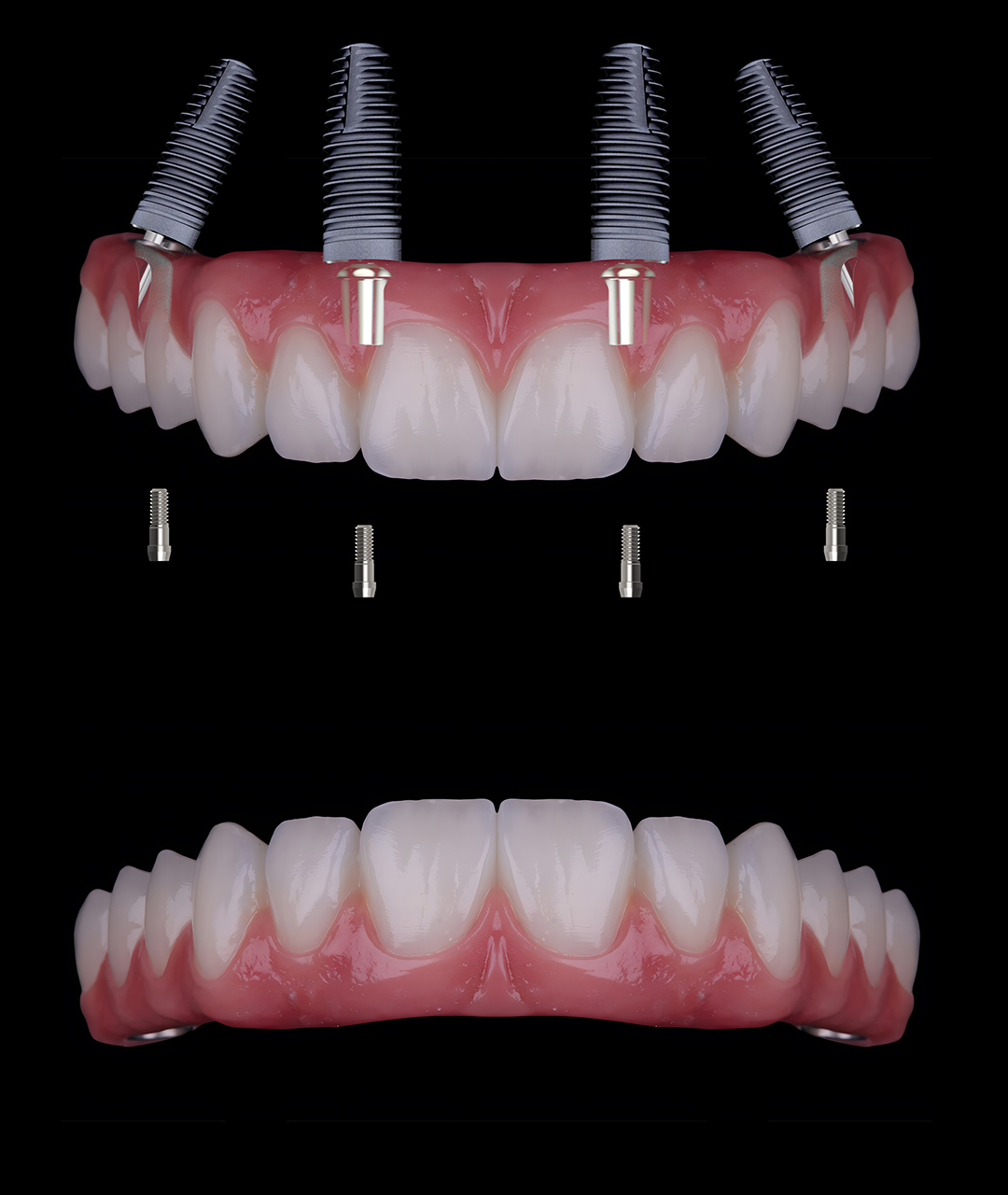 Zirconia Implant Bridges